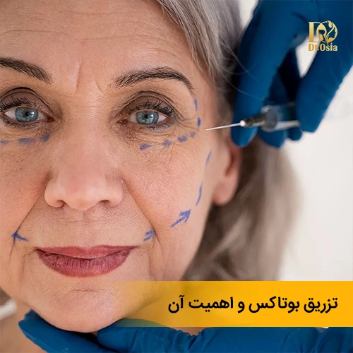 ویژگی های تزریق بوتاکس صورت