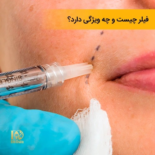 تزریق فیلر و ویژگی های آن