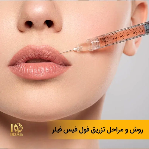 روش تزریق فیلر فول فیس چگونه است؟