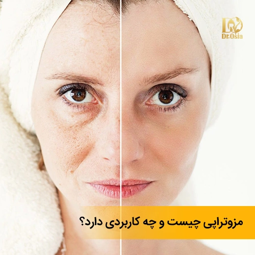 همه چیز در مورد مزوتراپی