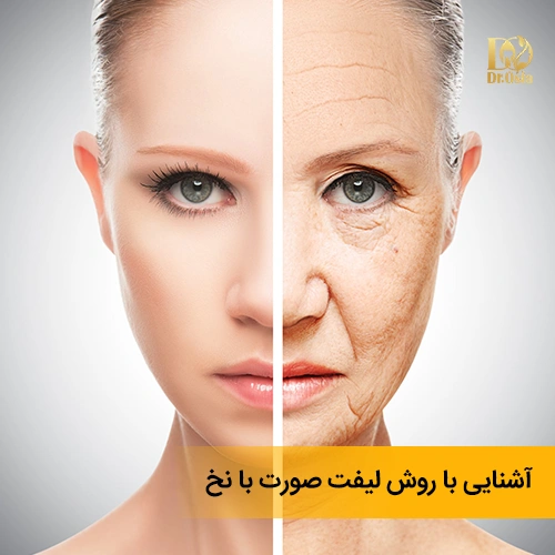 لیفت با نخ چیست؟