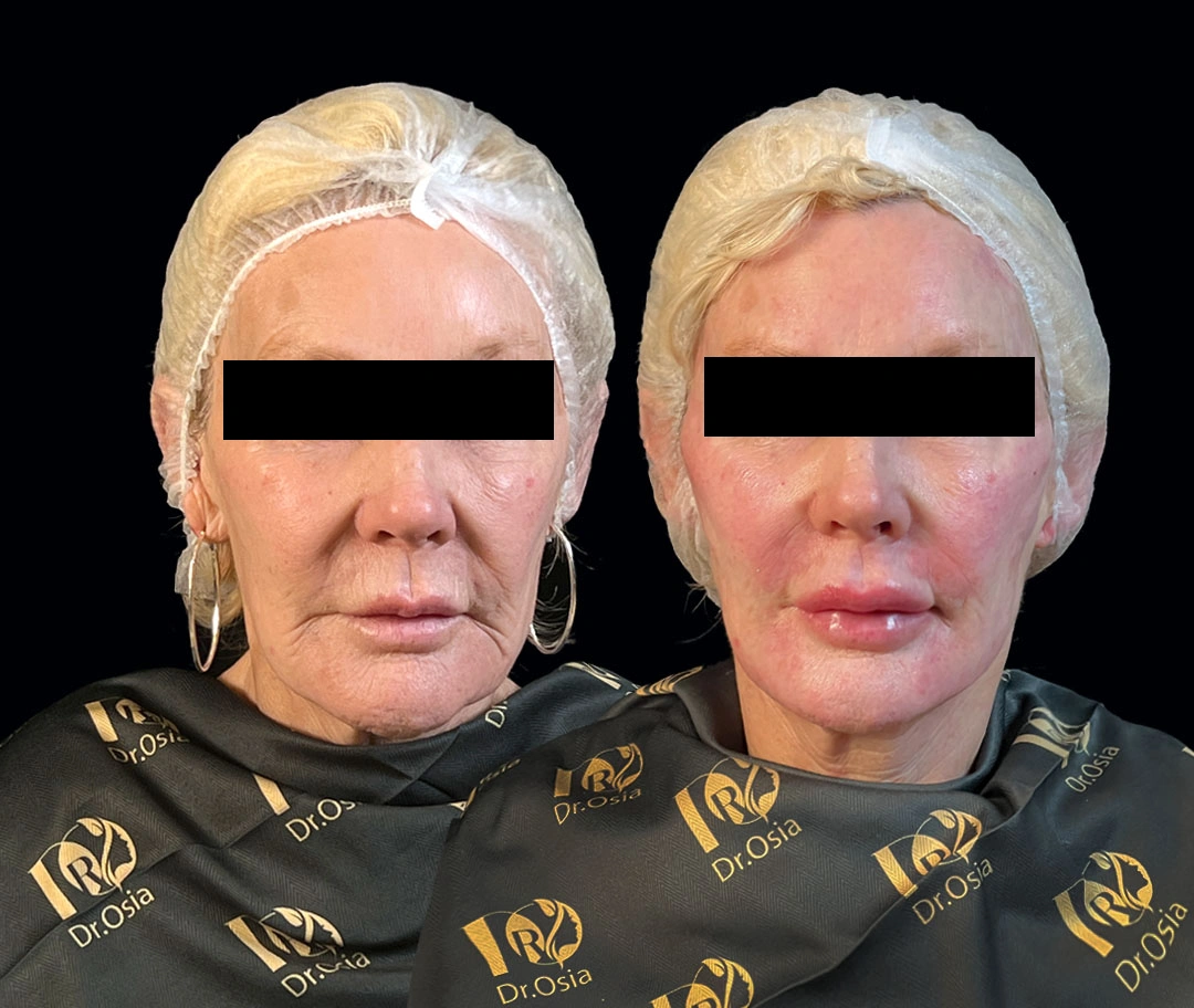 نمونه تزریق فیلر فول فیس