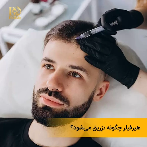 مدل و روش تزریق هیر فیلر
